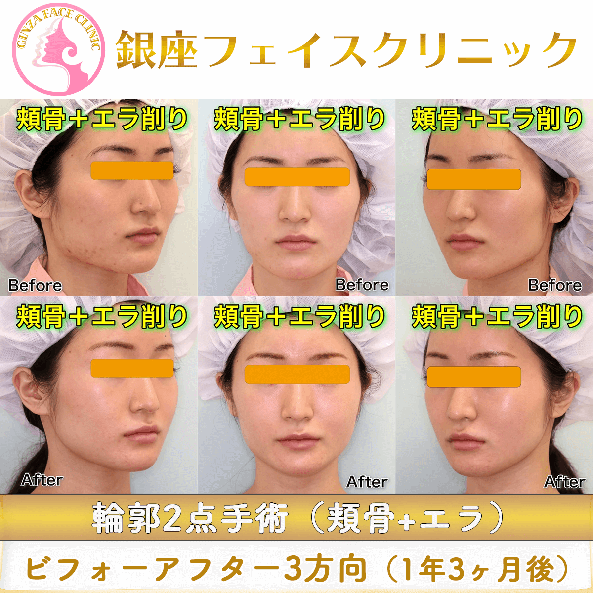 頬骨とエラを整える輪郭2点手術のビフォーアフター（術後1年3か月）