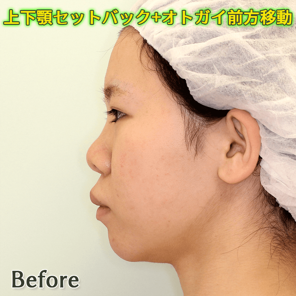 上下顎セットバック+オトガイ形成のビフォーアフター症例写真