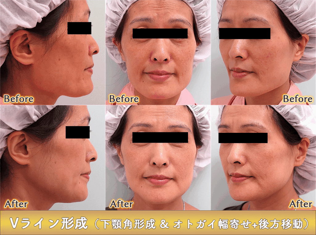 40代後半でのVライン形成の症例写真｜エラ下顎角形成&オトガイ幅寄せ+後方移動
