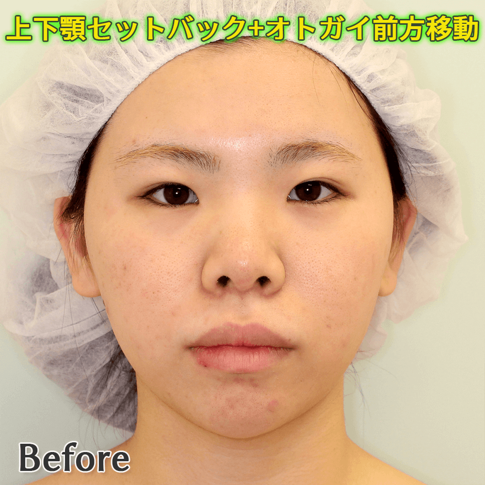 上下顎セットバック+オトガイ形成のビフォーアフター症例写真