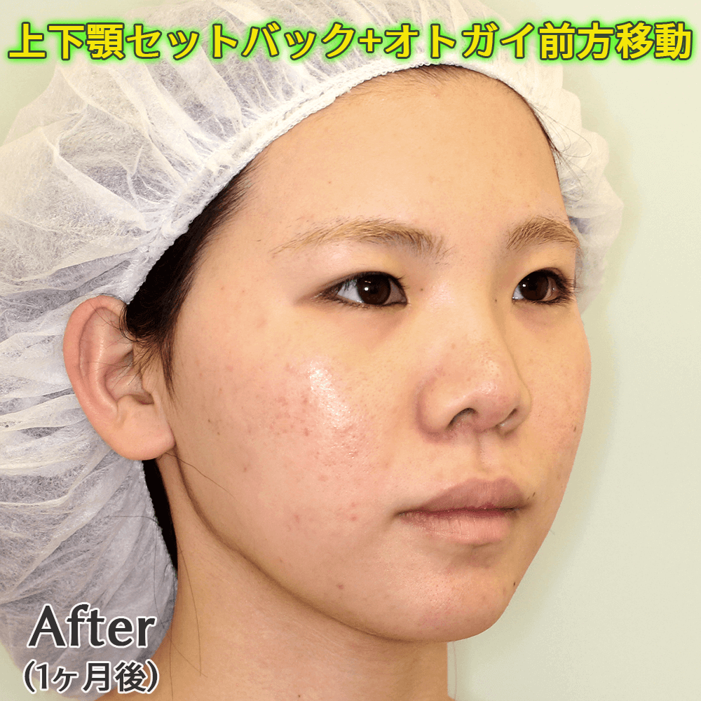 上下顎セットバック+オトガイ形成のビフォーアフター症例写真