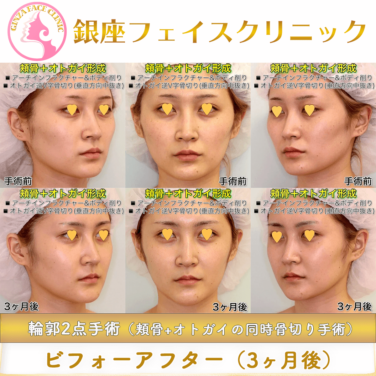 輪郭2点（頬骨+オトガイ）_ビフォーアフター症例写真_3ヶ月後