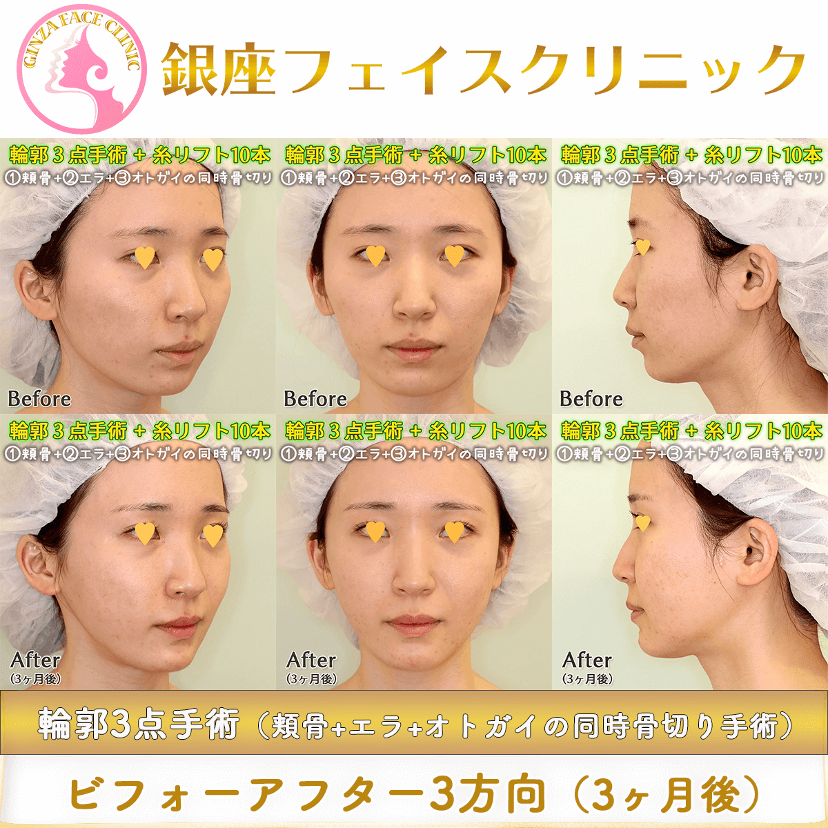輪郭3点手術（頬骨・エラ・オトガイの同時骨切り手術）のビフォーアフター症例写真