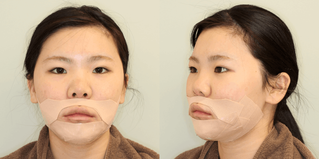 上下顎セットバック手術後のテーピング固定