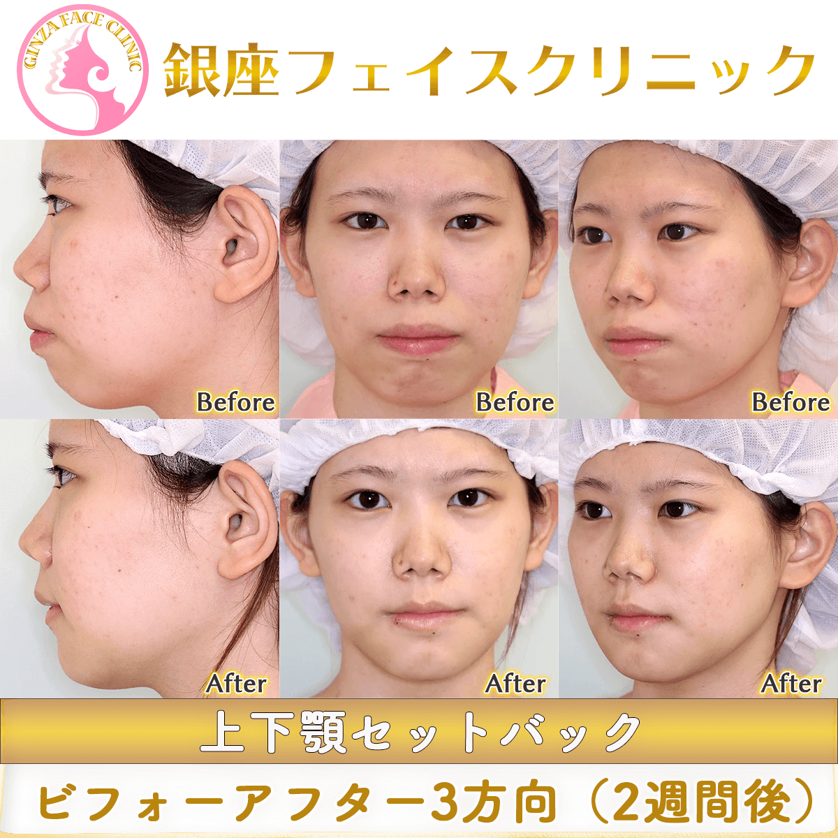 上下顎セットバックのビフォーアフター症例写真｜輪郭が整うと目鼻立ちも整う。