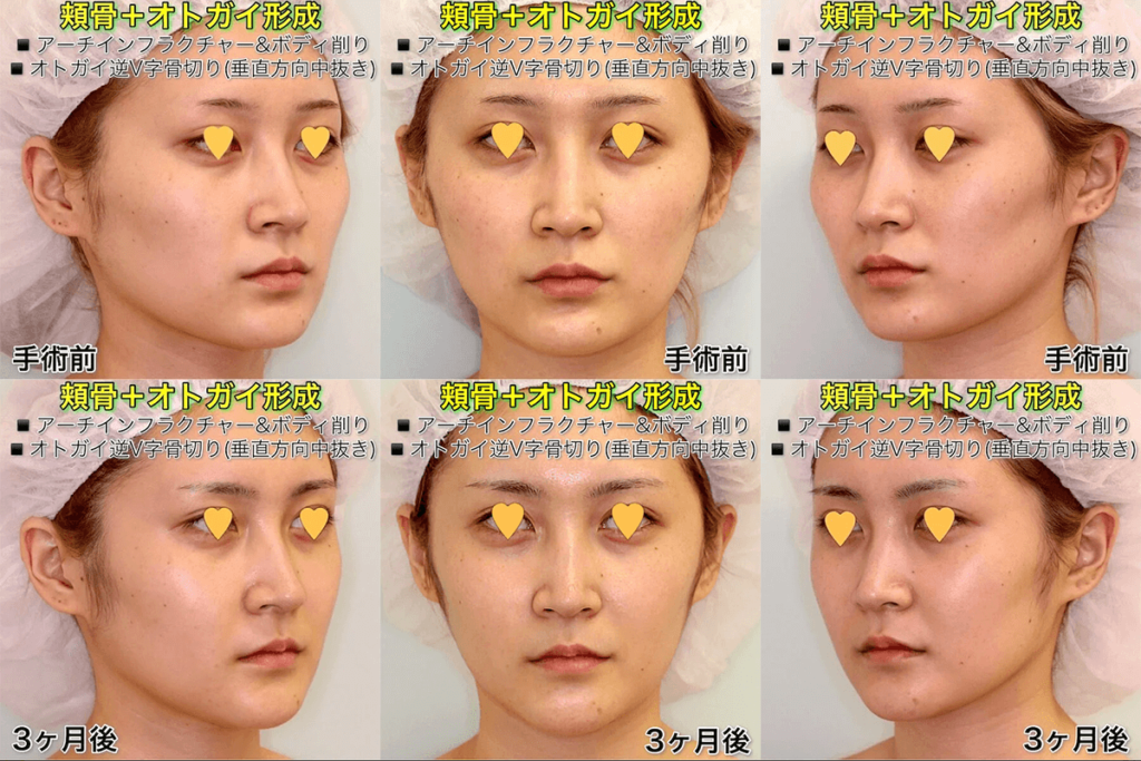 輪郭2点手術（頬骨+オトガイ）のビフォーアフター症例写真