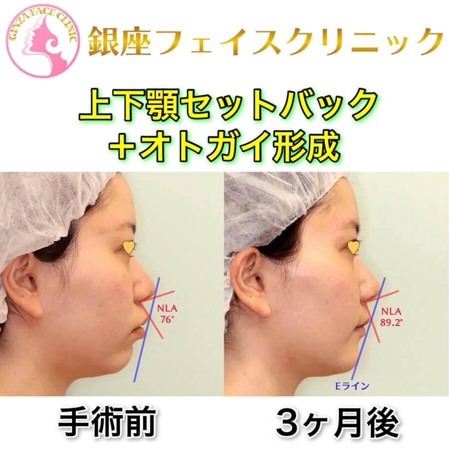 上下顎セットバックのビフォーアフター症例写真｜Eラインと鼻唇角（NLA）