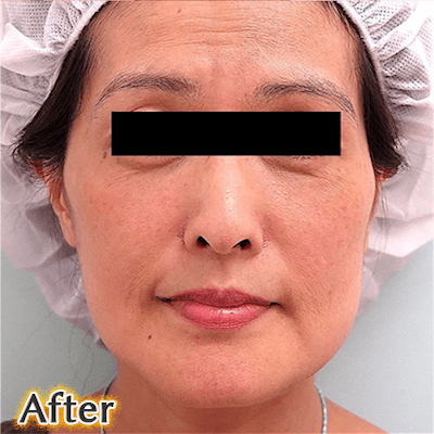 40代後半でのVライン形成の症例写真_3方向