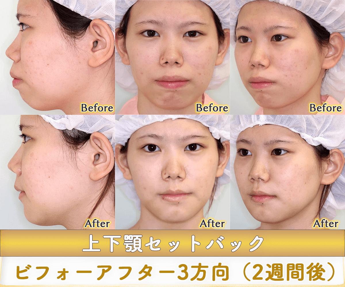 上下顎セットバックのビフォーアフター症例写真｜輪郭が整うと目鼻立ちも整う。