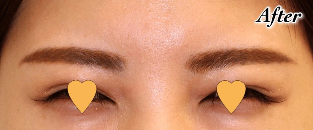 眉間のしわボツリヌストキシン注射｜ビフォーアフター症例写真