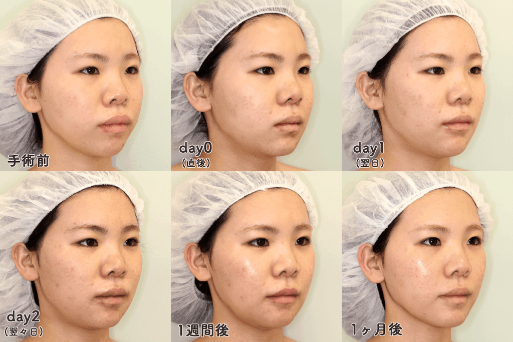 上下顎セットバック+オトガイ形成｜手術後の腫れの経過（1ヶ月間）