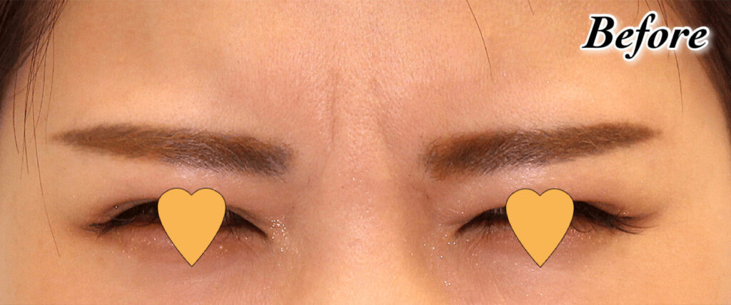 眉間のしわボツリヌストキシン注射｜ビフォーアフター症例写真
