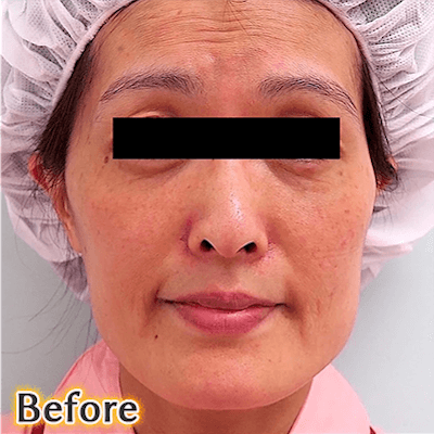 40代後半でのVライン形成の症例写真_3方向