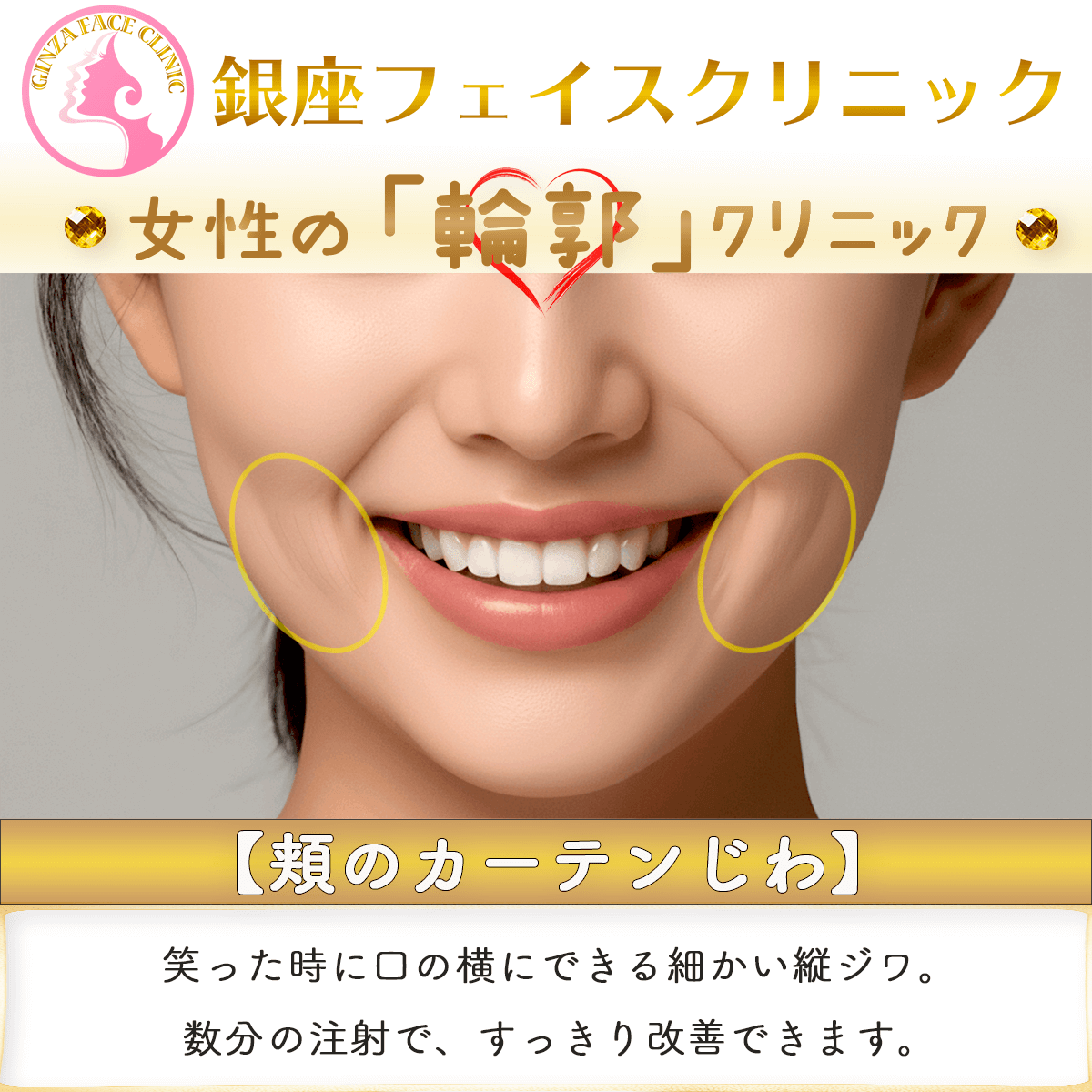 頬のカーテンじわ｜数分間の注射で改善