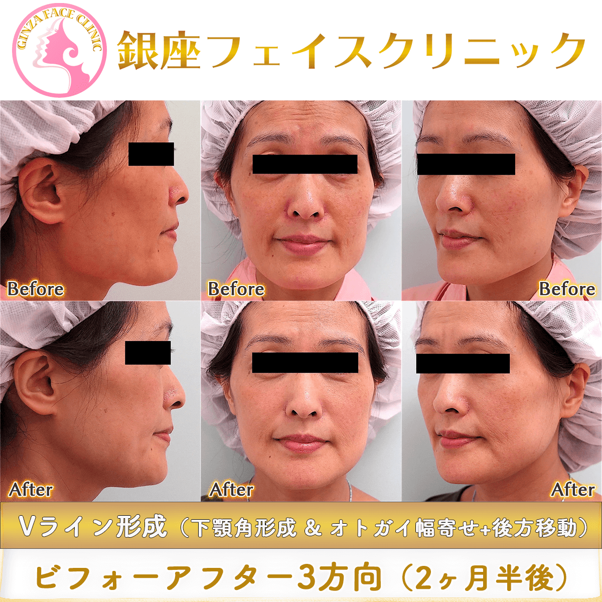 40代後半でのVライン形成の症例写真_3方向