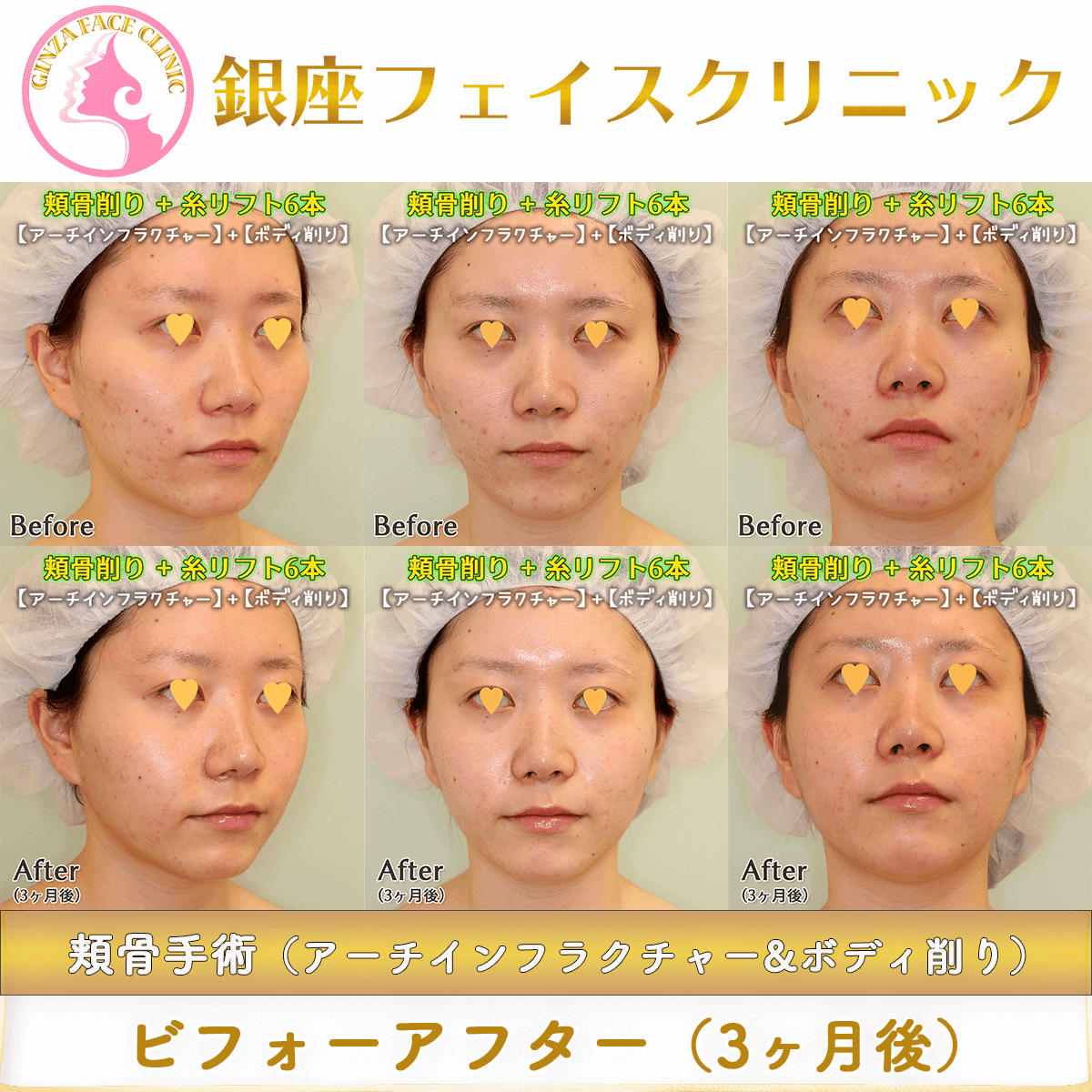 頬骨削り 糸リフト 3ヶ月後 症例写真 銀座フェイスクリニック