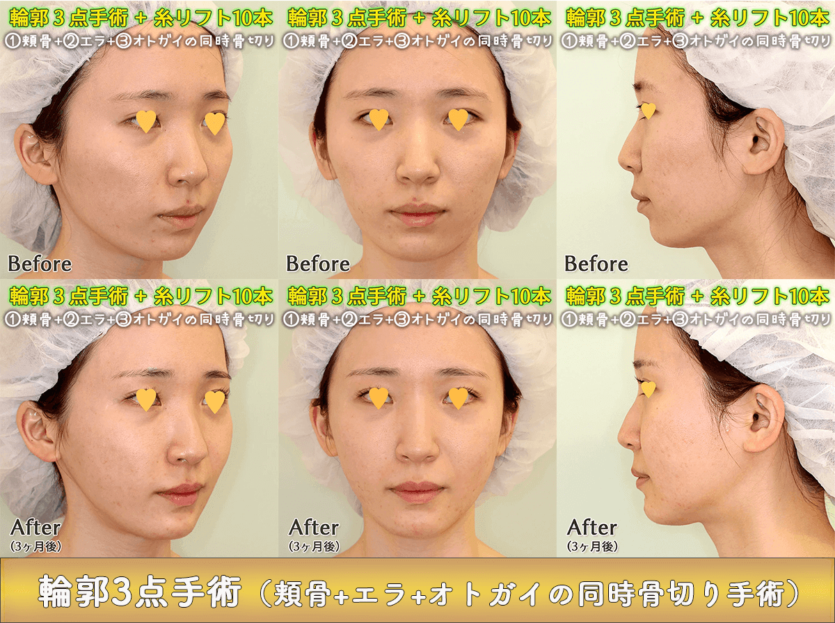 輪郭3点手術（頬骨＋エラ＋オトガイ）のビフォーアフター症例写真