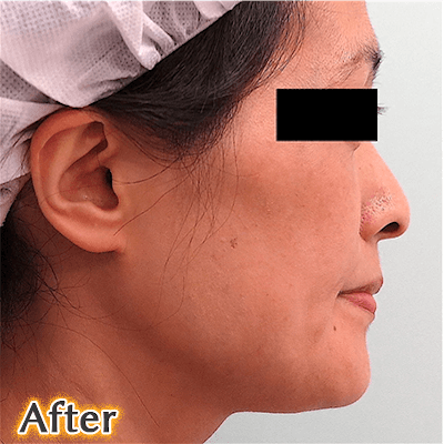 40代後半でのVライン形成の症例写真_3方向