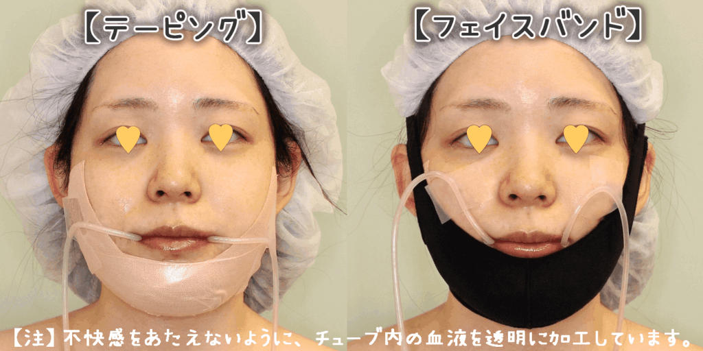 エラやVライン手術後のドレーンの様子