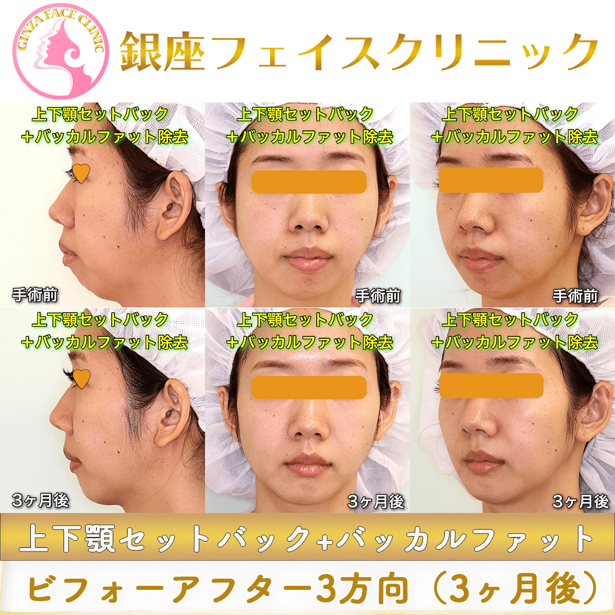 上下顎セットバックとバッカルファット除去による症例写真（口ゴボ・上下顎前突に対する術前と術後3か月の比較、正面・斜位・側面）