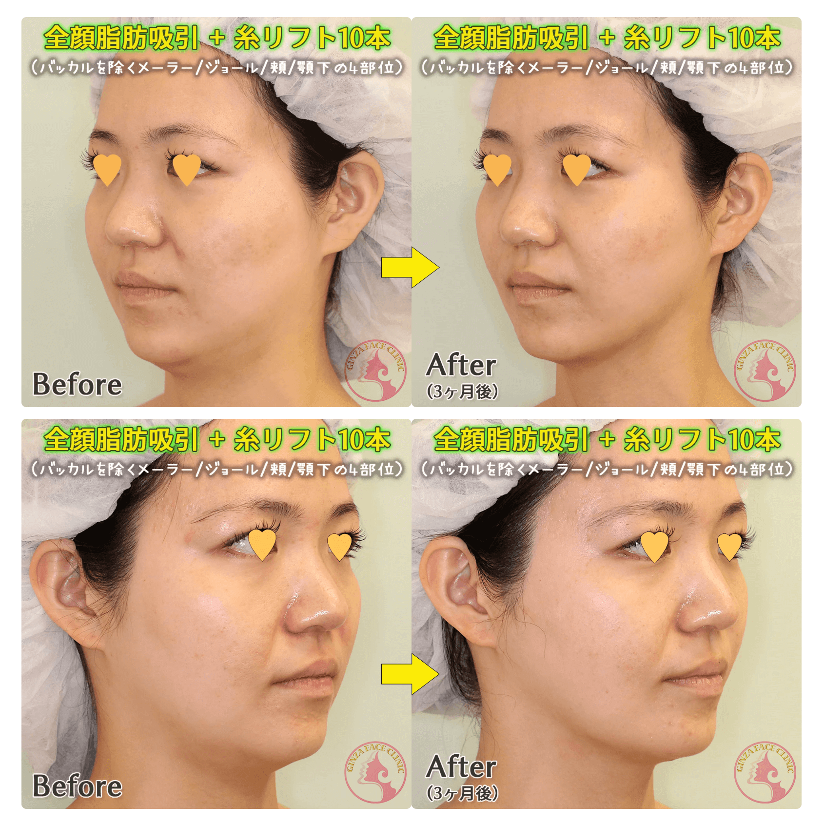 全顔脂肪吸引（メーラー・ジョール・頬骨上・頬・顎下）のビフォーアフター症例写真