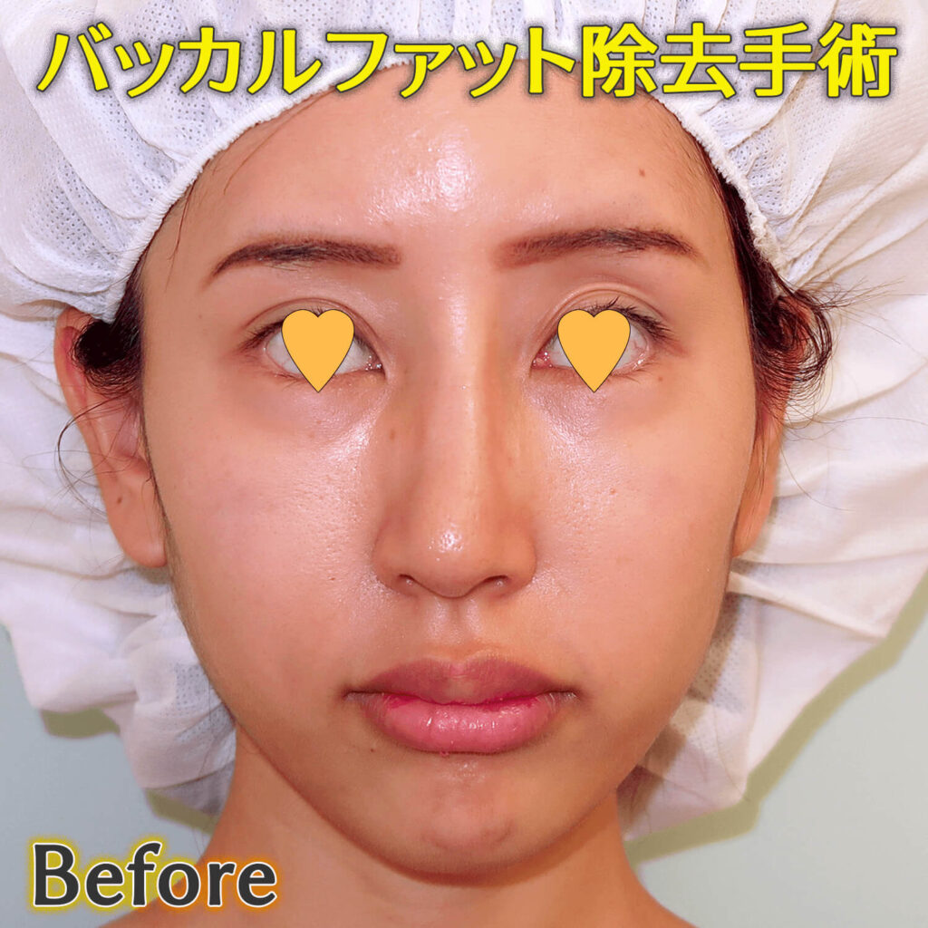 バッカルファット除去手術のビフォーアフター症例写真