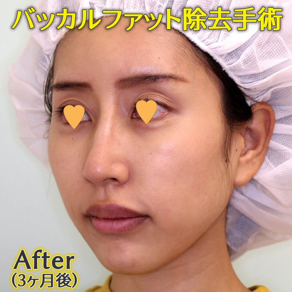 バッカルファット除去手術のビフォーアフター症例写真