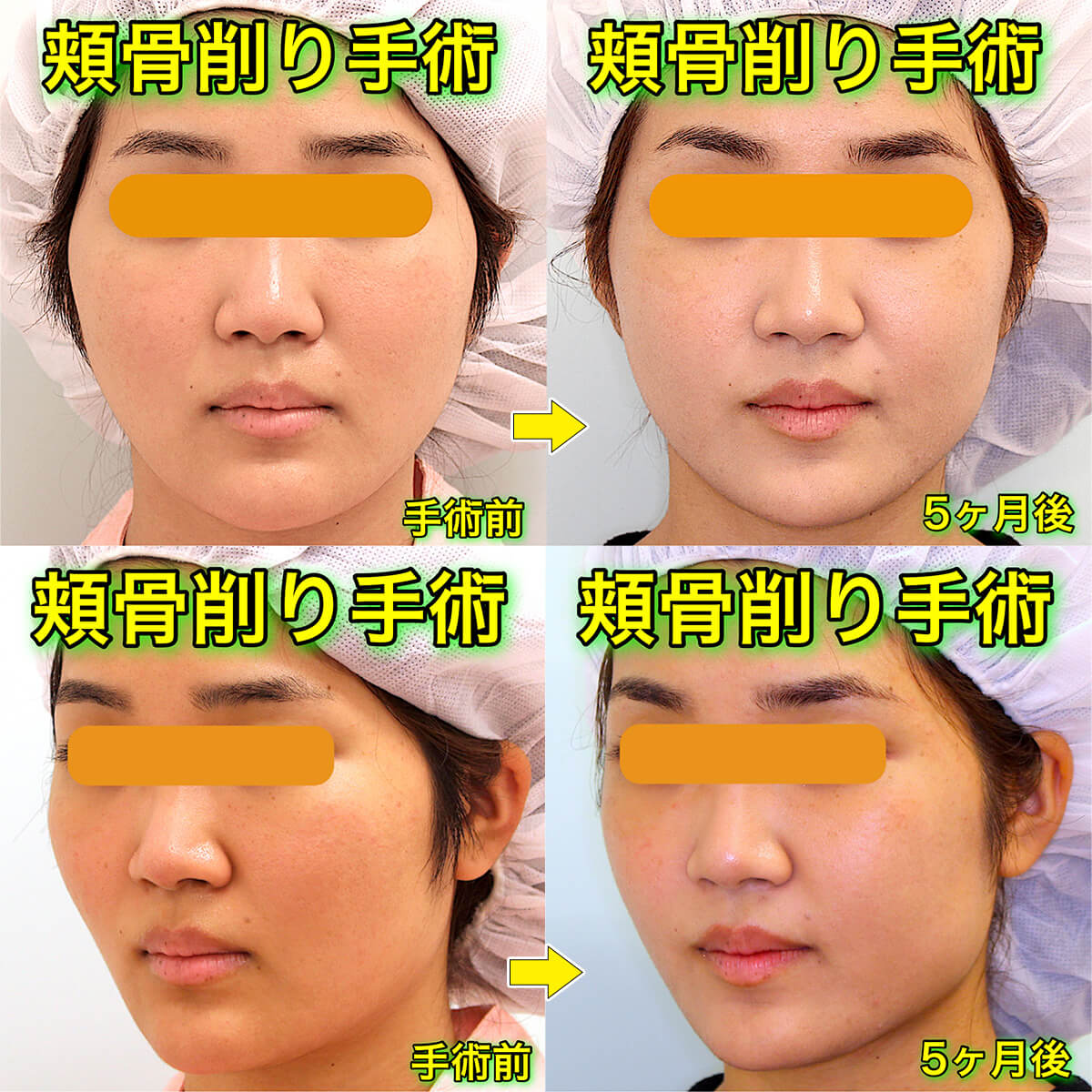 頬骨削り（アーチインフラクチャー&ボディ削り）のビフォーアフター症例写真