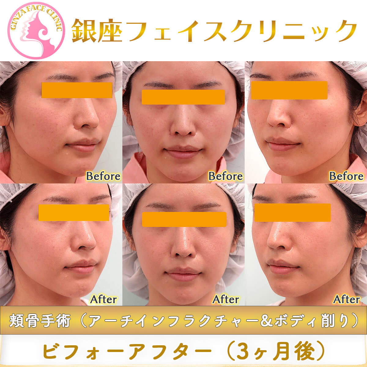 頬骨骨切り手術（アーチインフラクチャー&ボディ削り）のビフォーアフター症例写真