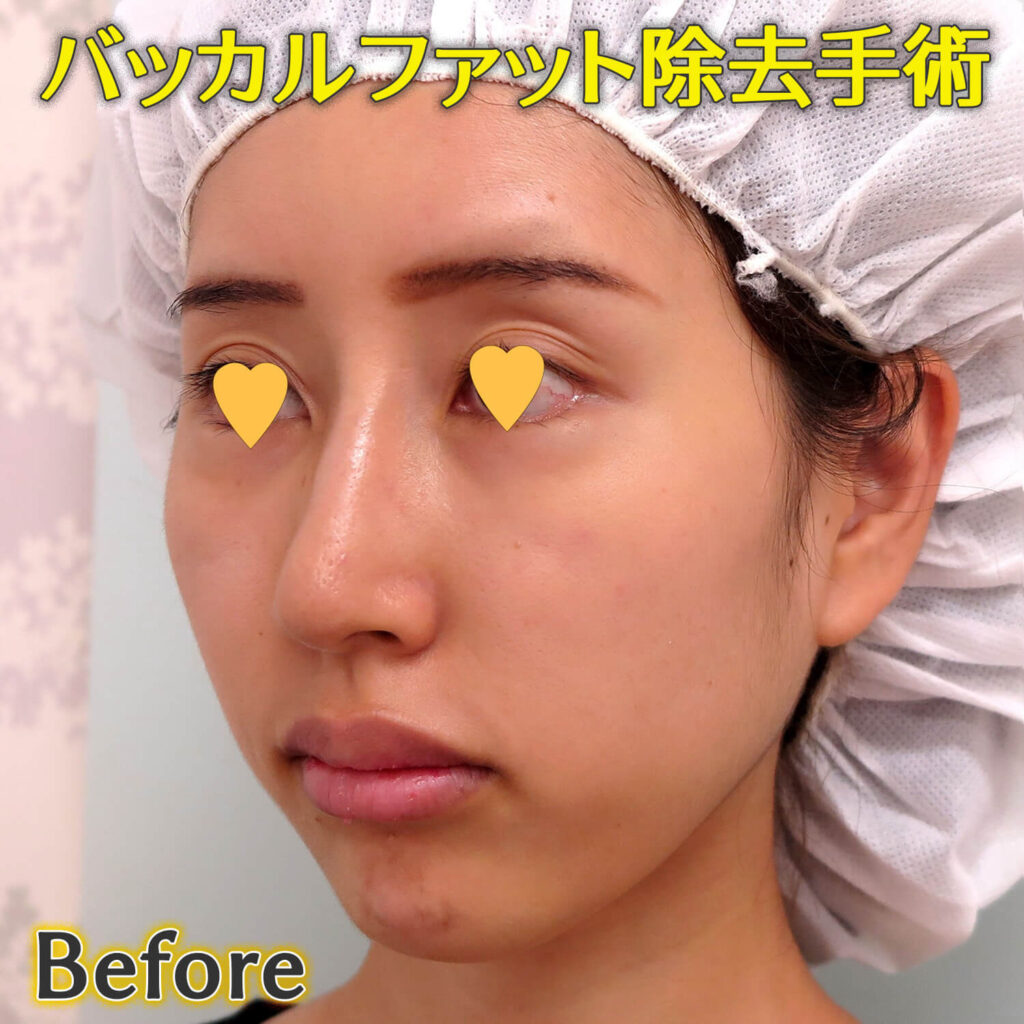 バッカルファット除去手術のビフォーアフター症例写真