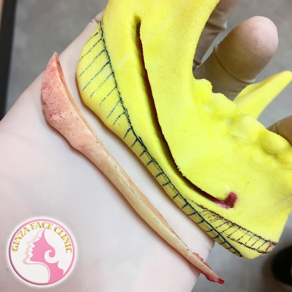 エラ骨切りでカットした骨片