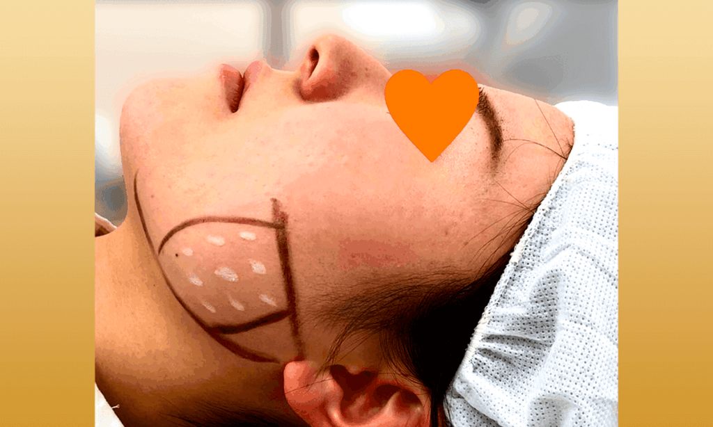 エラボトックス治療の施術風景