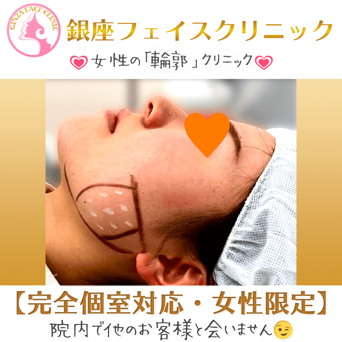 エラボトックス施術風景｜咬筋縮小注射