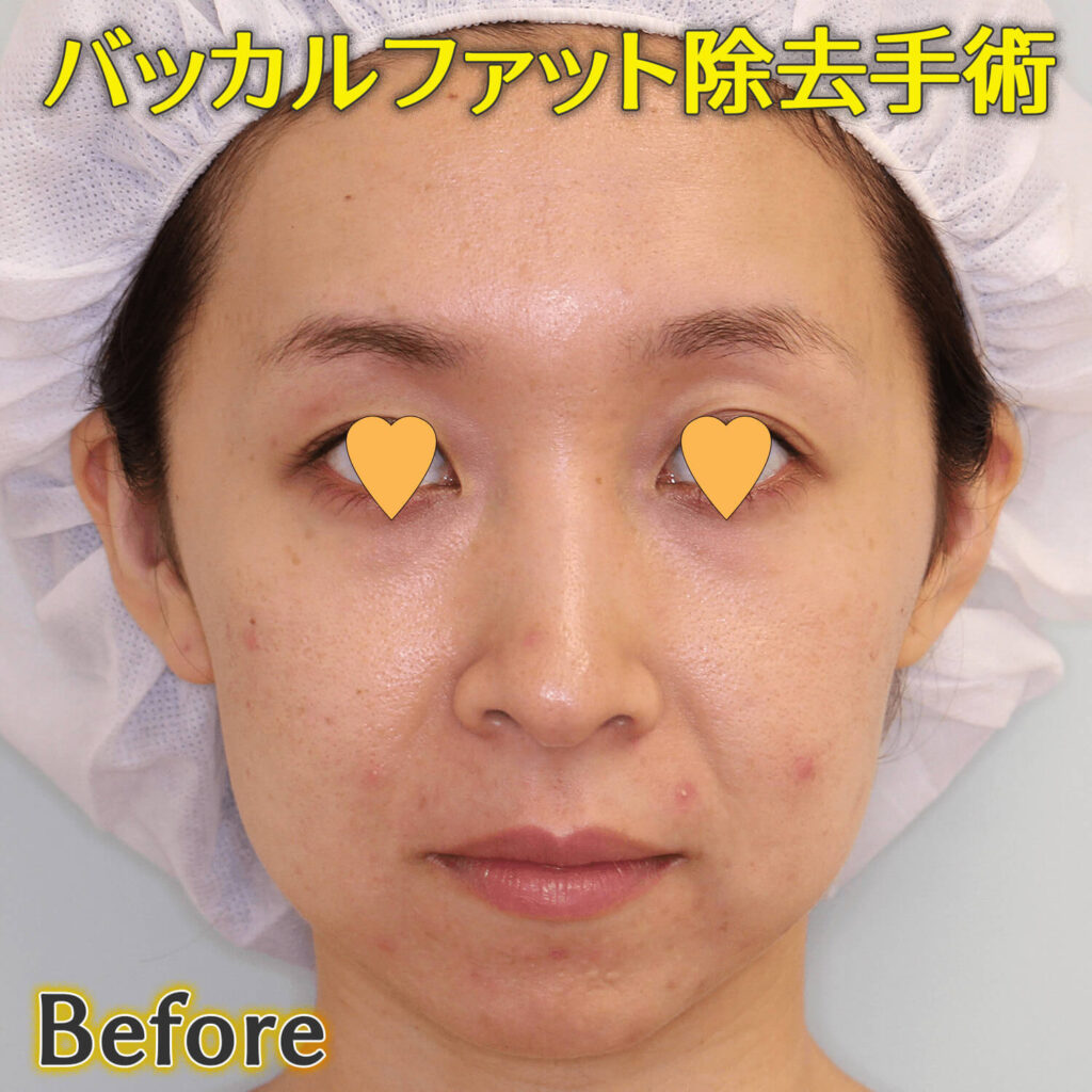 バッカルファット除去手術のビフォーアフター症例写真