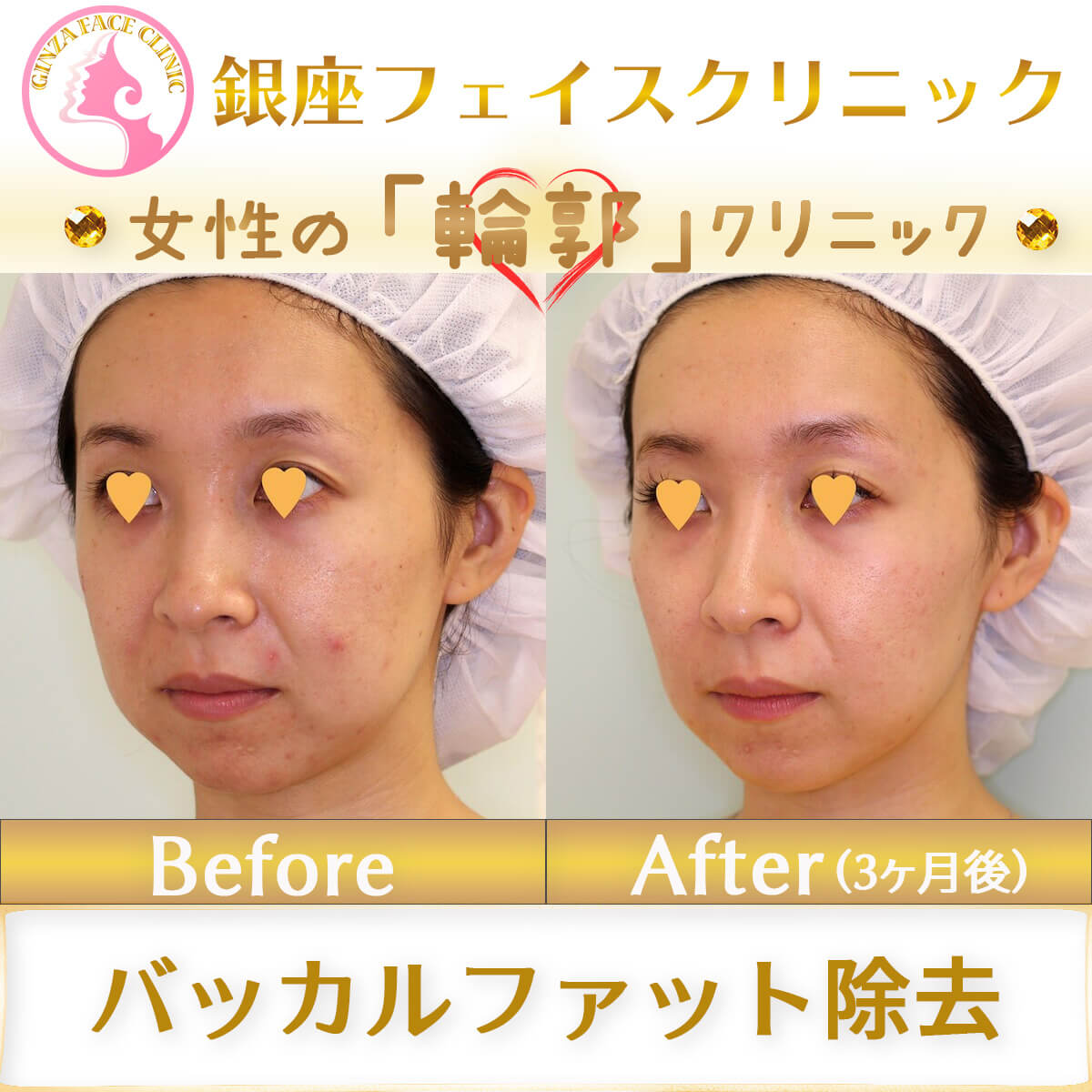 バッカルファット除去手術のビフォーアフター症例写真