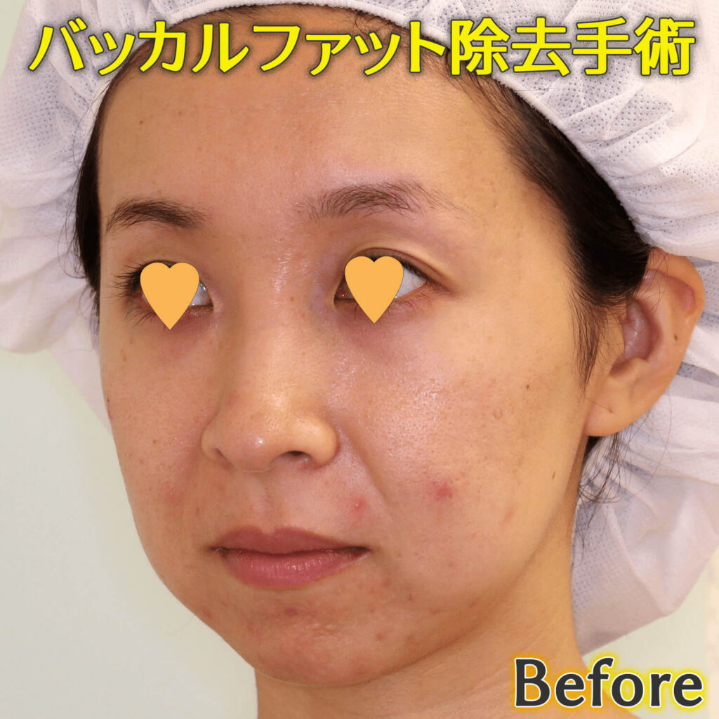 バッカルファット除去手術のビフォーアフター症例写真