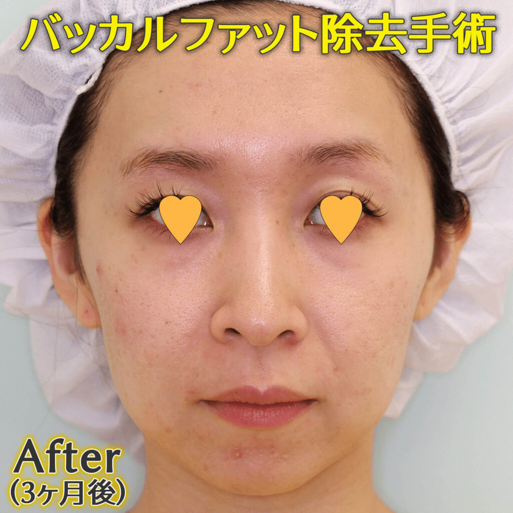 バッカルファット除去手術のビフォーアフター症例写真