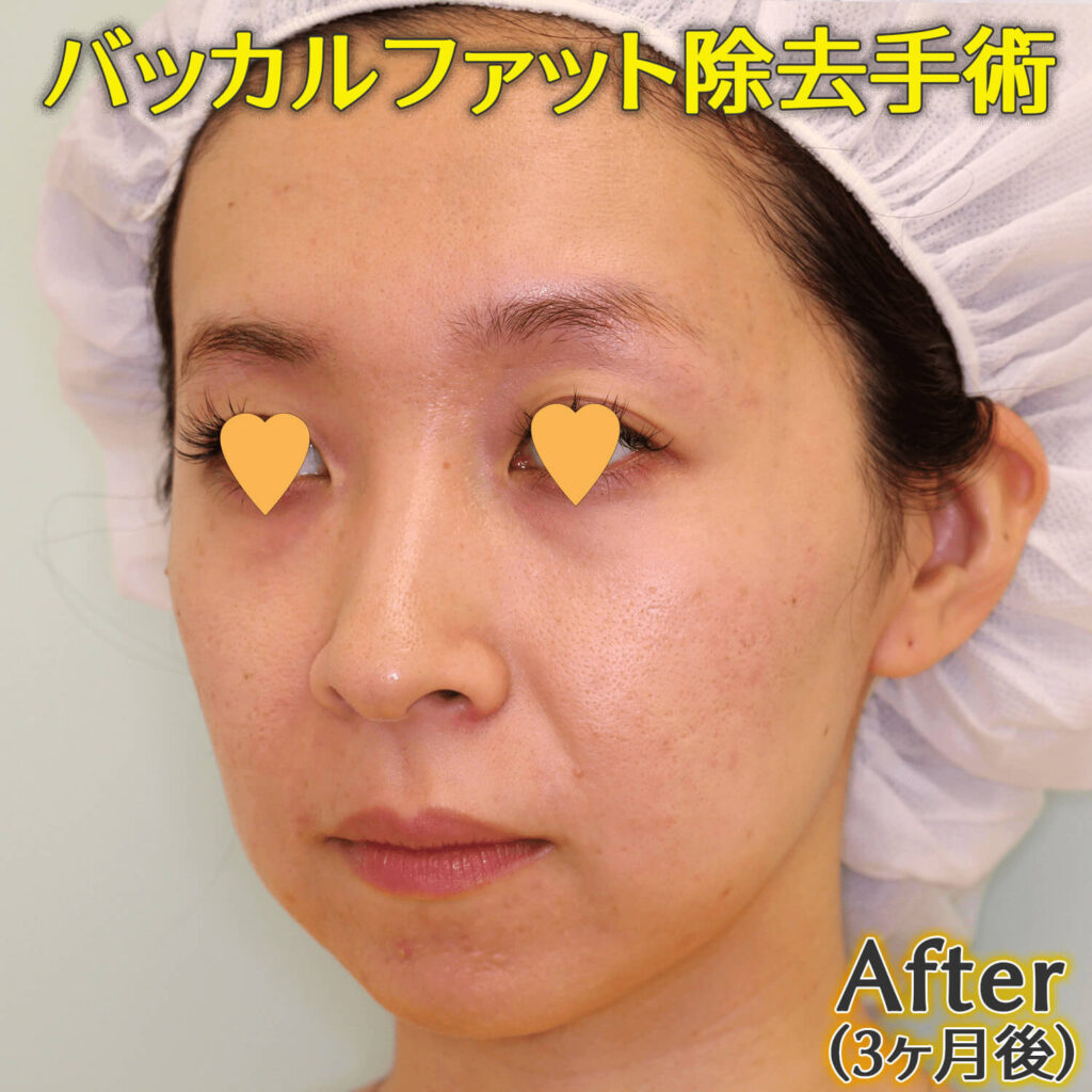 バッカルファット除去手術のビフォーアフター症例写真