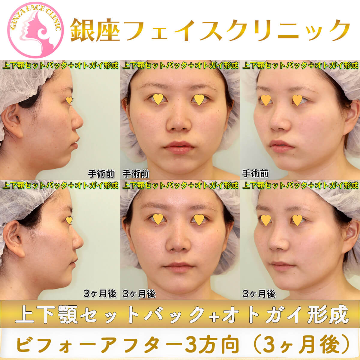 上下顎セットバック+オトガイのビフォーアフター症例写真