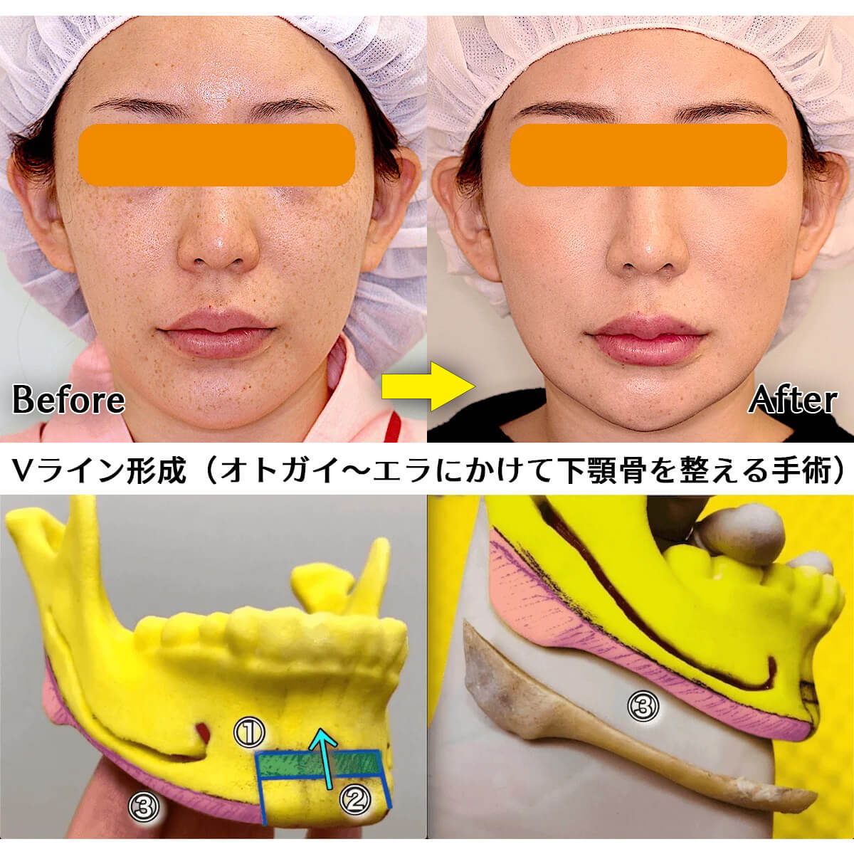 Vライン形成のビフォーアフター症例写真とデザイン