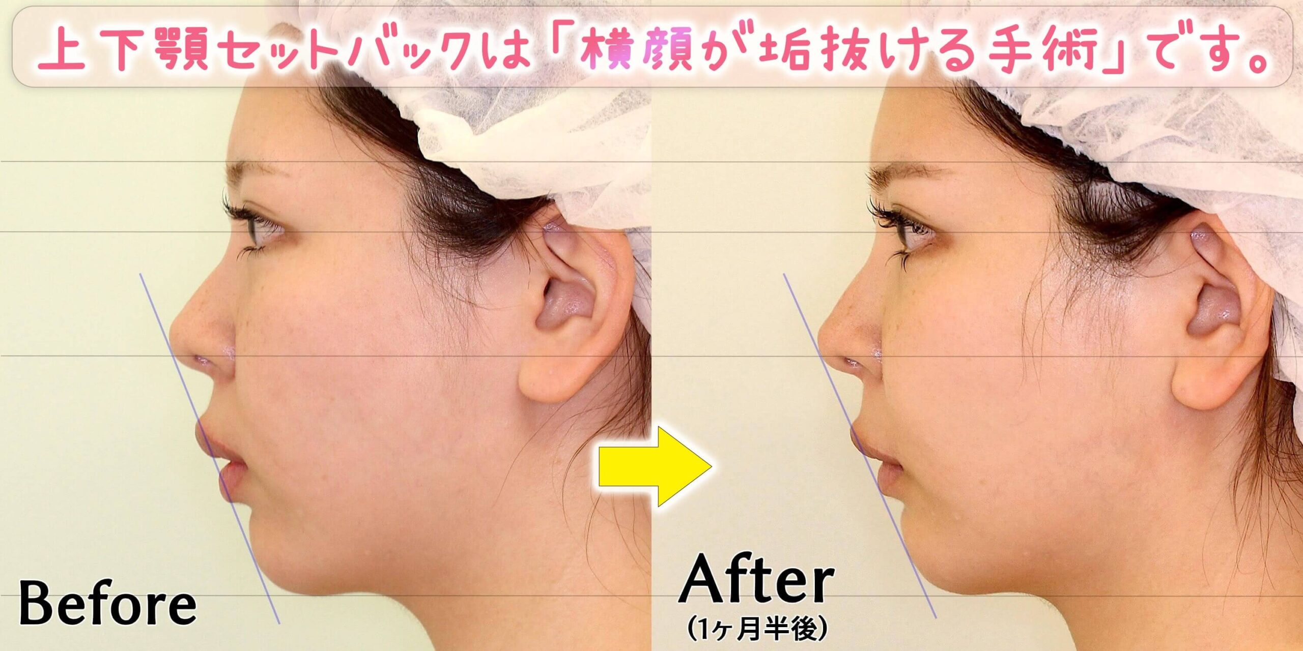 上下SBは横顔が垢抜ける手術 (1)