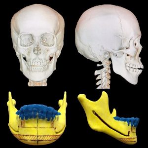 骨削り手術の術前検査｜CT・3D骨格模型