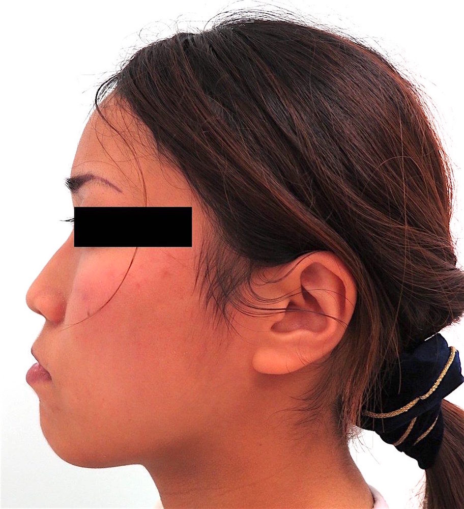 上下顎セットバックの症例写真（ビフォーアフター）