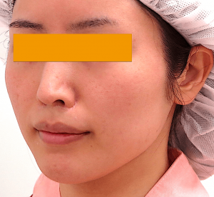 頬骨削り手術の症例写真｜術前・左斜め