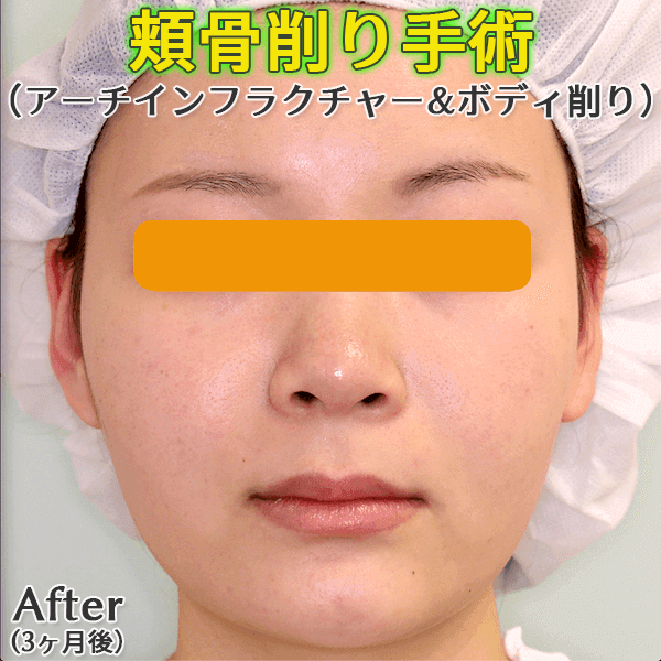 頬骨削り手術のビフォーアフター症例写真｜アーチインフラクチャーとボディ削り