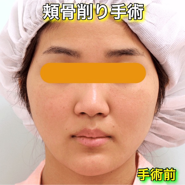 頬骨削り手術の症例写真｜手術前（Before）