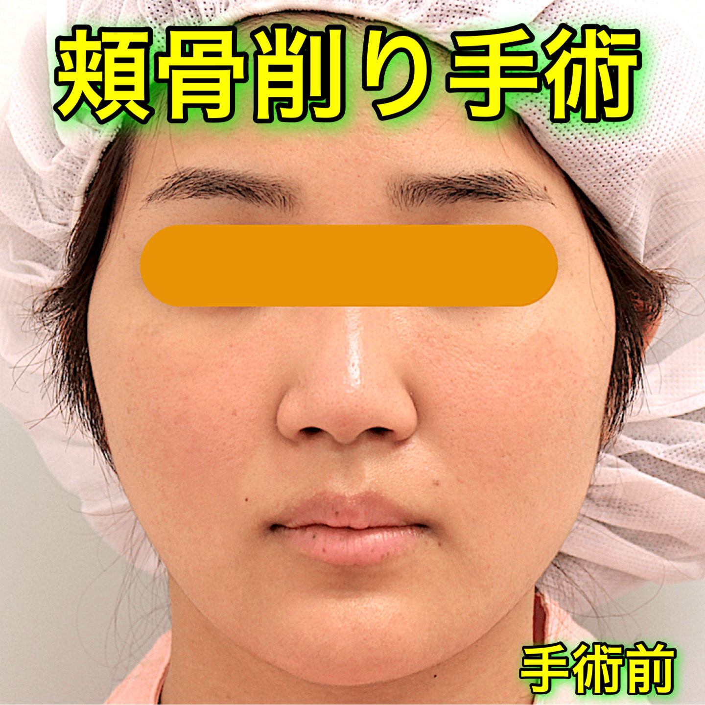 頬骨削り手術の症例写真｜BeforeAfter