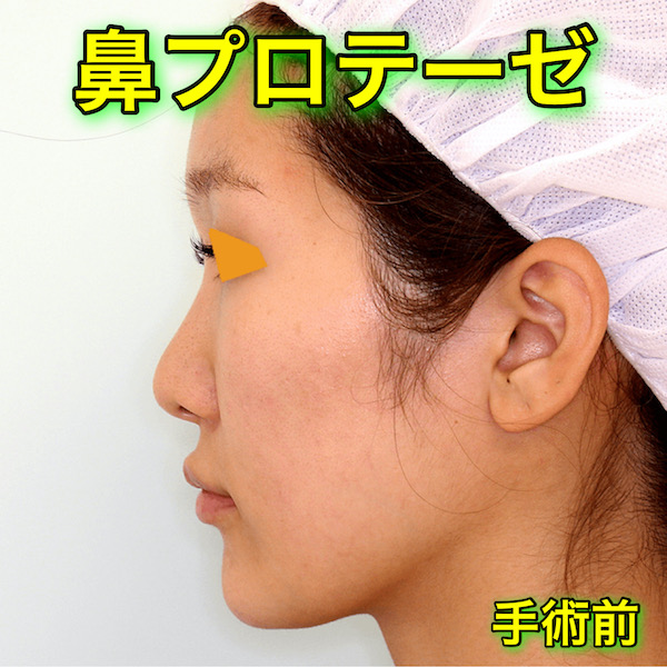 鼻プロテーゼの症例写真｜BeforeAfter
