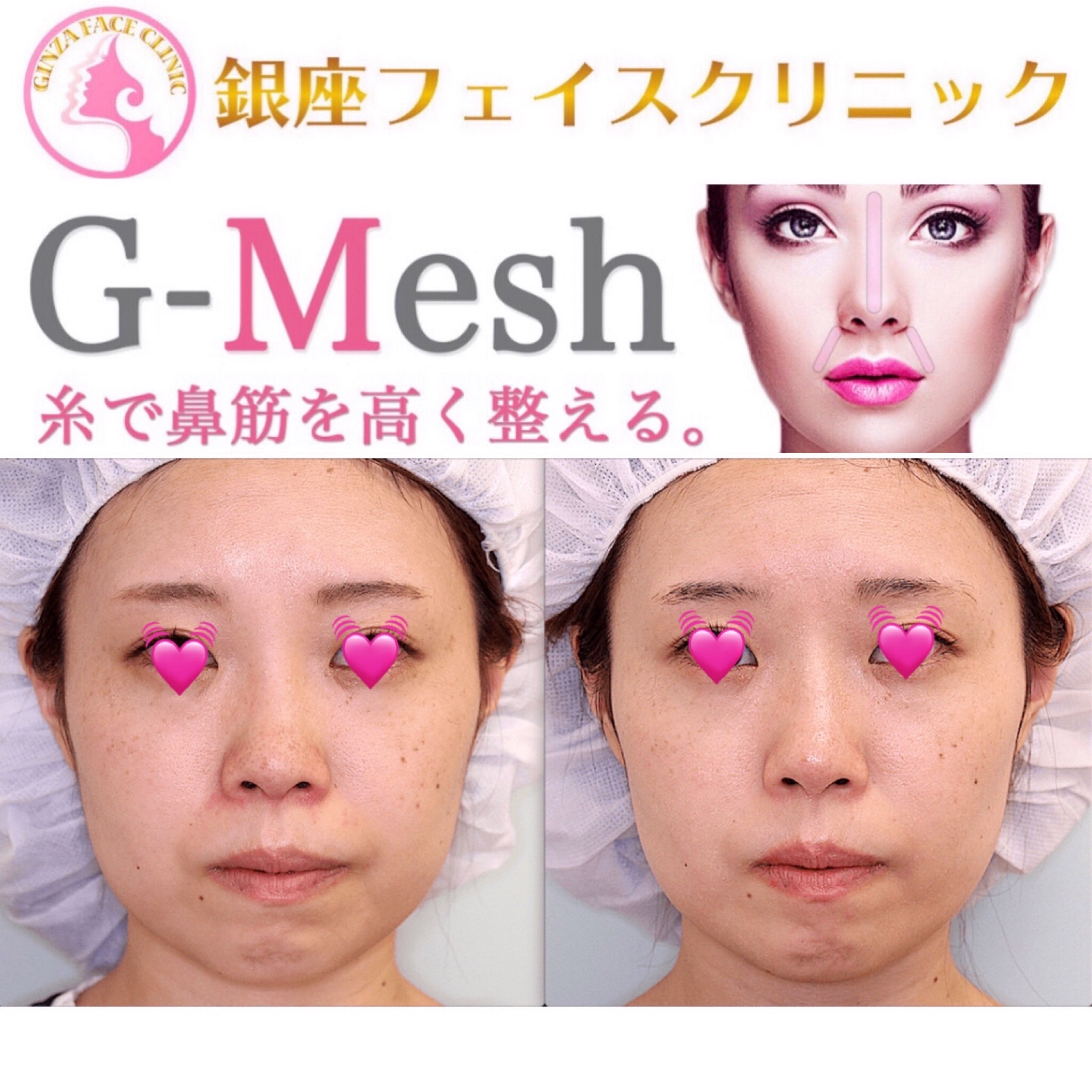 Gメッシュ（鼻）の症例写真 Before After