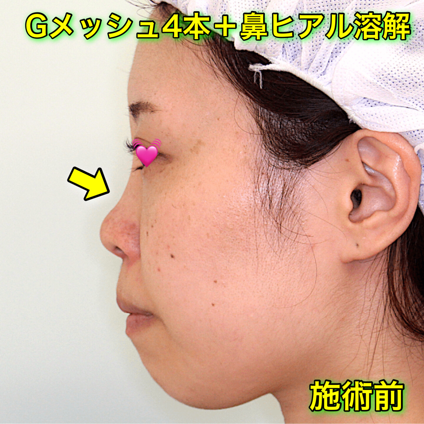 Gメッシュ（鼻）の症例写真 Before After